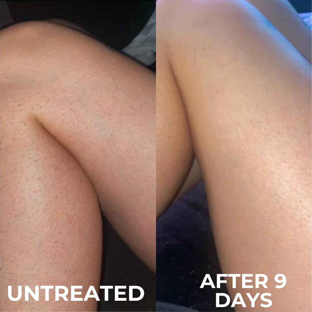 Advanced Triple Acid Complex for Keratosis Pilaris