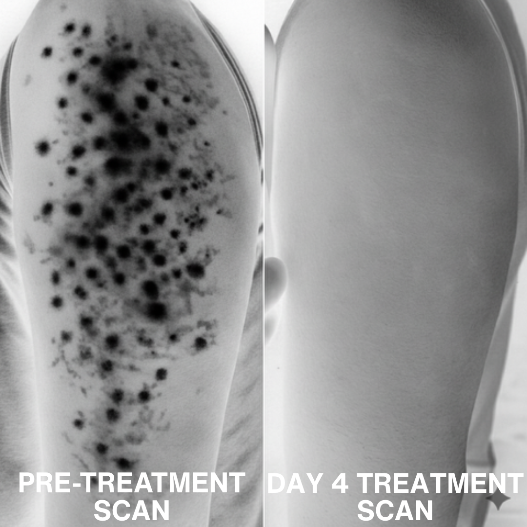 Advanced Triple Acid Complex for Keratosis Pilaris